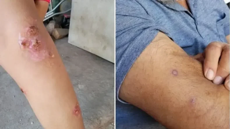 Hatay’da Uyuz Alarmı: Vakalar Yeniden Artış Gösterdi